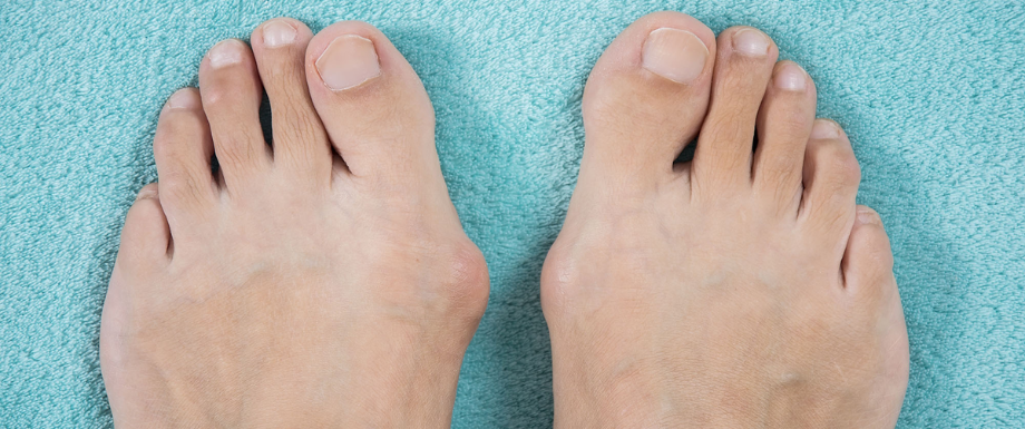 Diabetes and Feet – Bunions